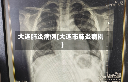 大连肺炎病例(大连市肺炎病例)