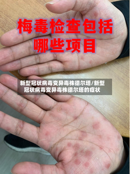 新型冠状病毒变异毒株德尔塔/新型冠状病毒变异毒株德尔塔的症状-第3张图片